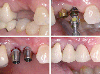 refaire ses dents en Tunisie