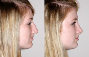 rhinoplastie aux ultrasons