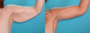 prix lifting bras en Tunisie