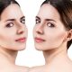 tout savoir sur la rhinoplastie