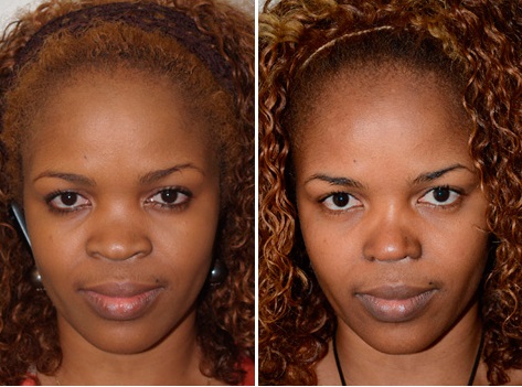 Rhinoplastie Ethnique Tunisie Chirurgie Esthetique Du Nez Rhinoplastie Ethnique Tunisie Chirurgie Esthetique Du Nez