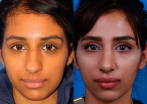 Rhinoplastie ethnique en Tunisie