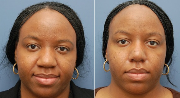Rhinoplastie Ethnique Tunisie Chirurgie Esthetique Du Nez Rhinoplastie Ethnique Tunisie Chirurgie Esthetique Du Nez