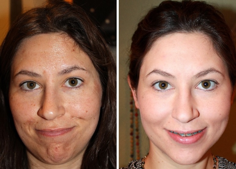 Peeling Tunisie ️ peeling visage superficiel, TCA ou profond