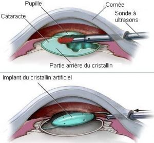 operation cataracte Tunisie