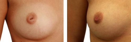 Résultat de la chirurgie des mamelons ombiliqués