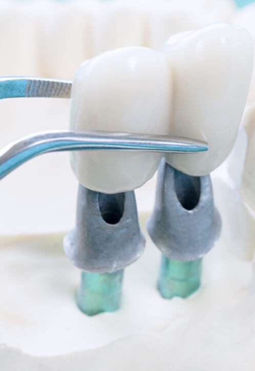 prix implant dentaire Tunisie