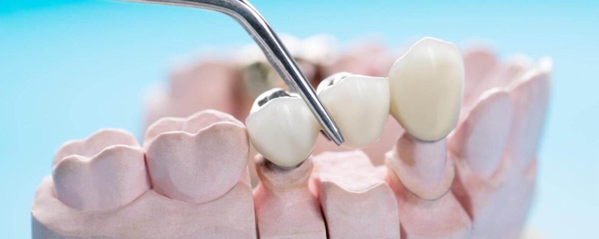 remplacer-une-dent-manquante