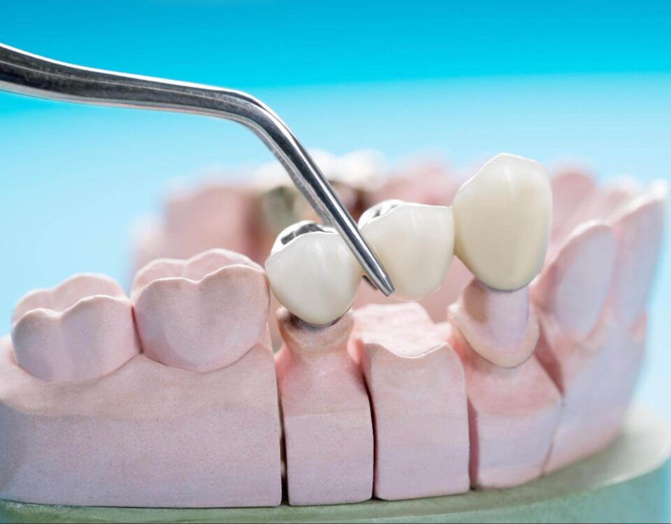 remplacer-une-dent-manquante