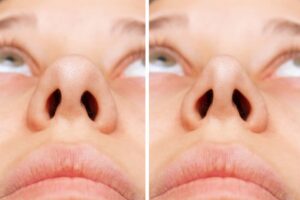 cicatrices-rhinoplastie