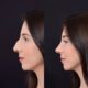 résultat-final-rhinoplastie