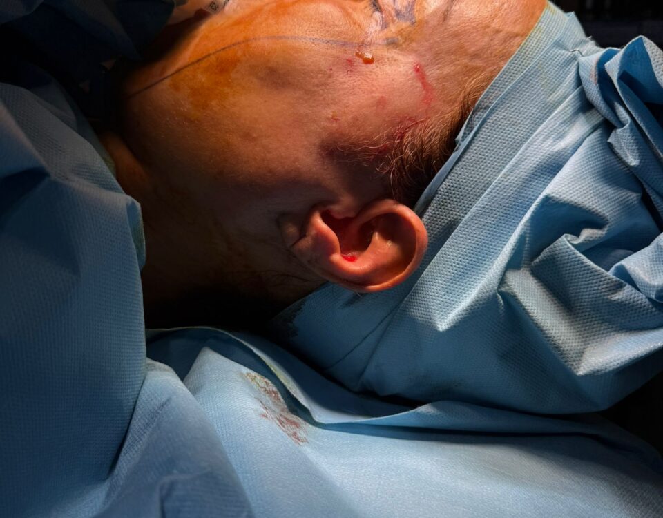 lifting-coréen-tunisie