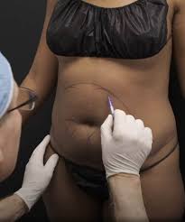 liposuccion