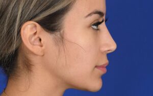 rhinoplastie-barbie-tunisie