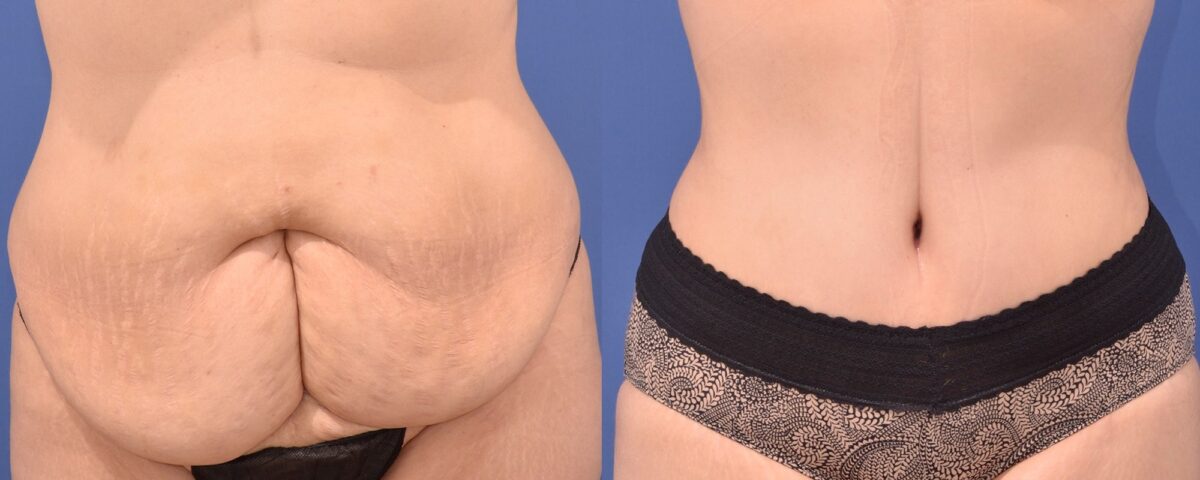 abdominoplastie-après-grossesse