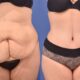 abdominoplastie-après-grossesse