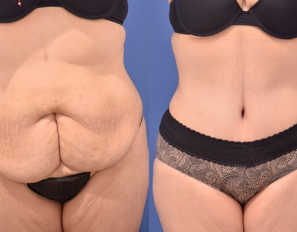abdominoplastie-après-grossesse