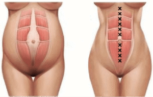 Chirurgie-diastasis-abdominal-tunisie