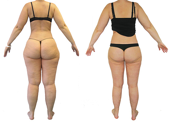 Liposuccion WAL-lipoedème