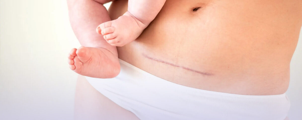 cicatrice-césarienne