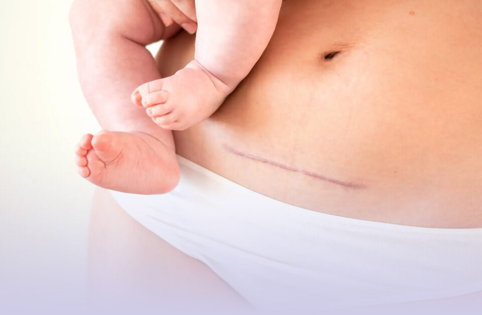 cicatrice-césarienne