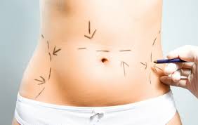 Mini-abdominoplastie-tunisie