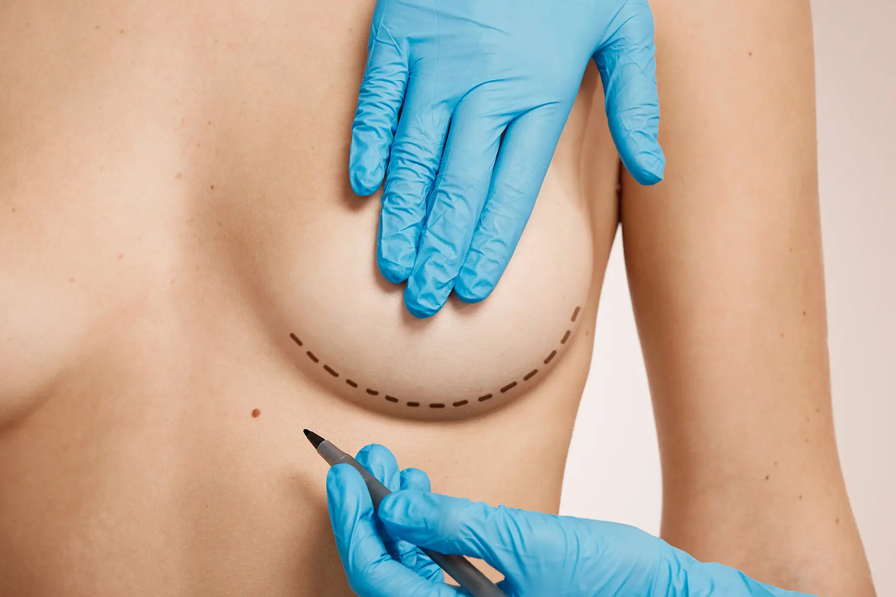 Chirurgie seins Tunisie