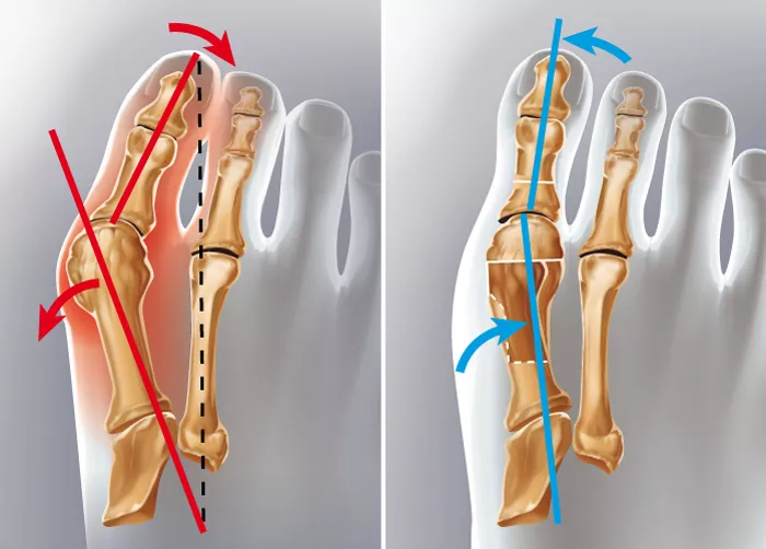 Hallux valgus en Tunisie